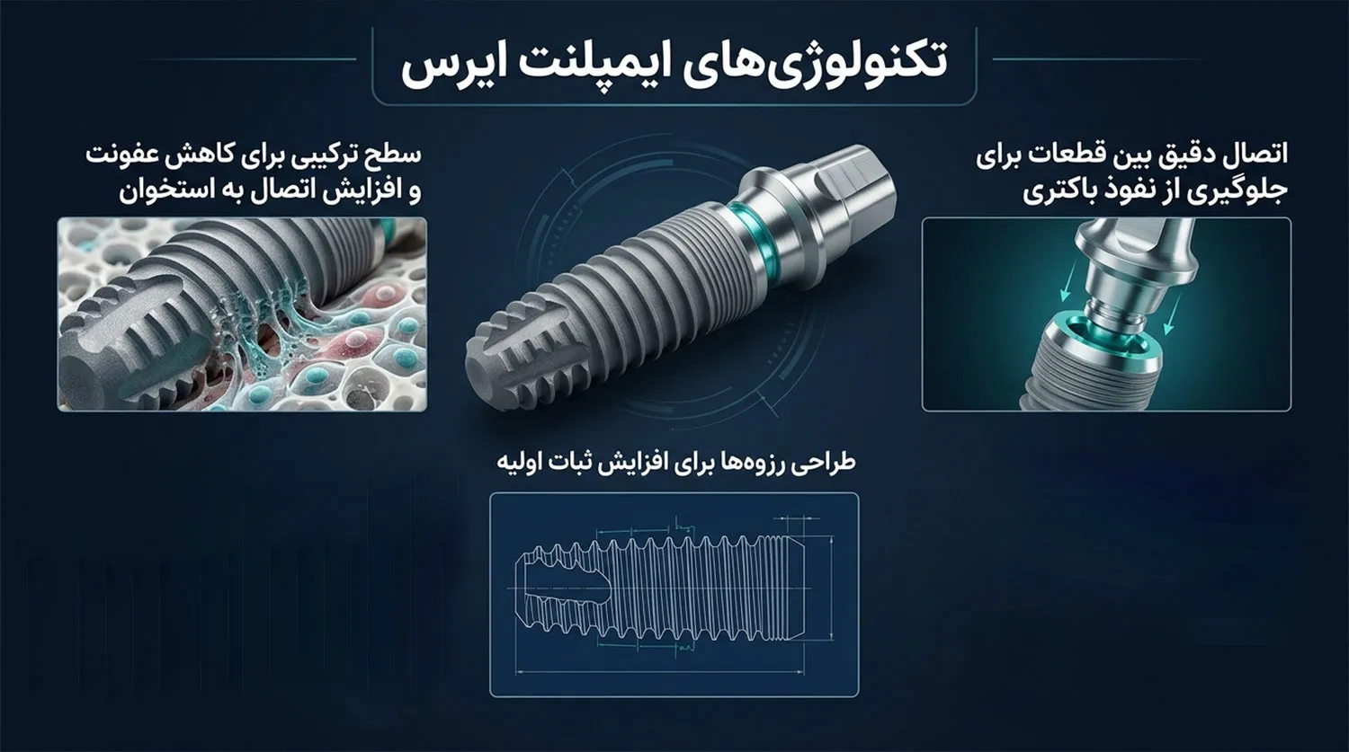 تکنولوژی ایمپلنت آیرس 