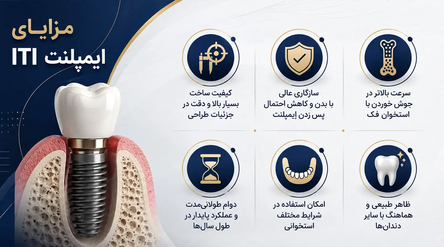 مزایای ایمپلنت ای تی ای iti implant advantages