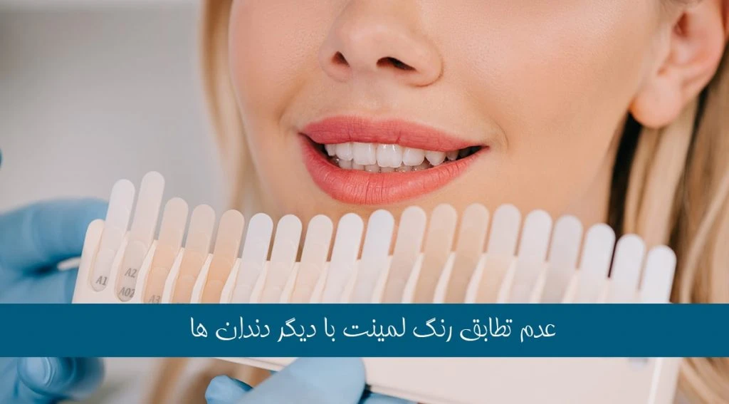 عدم تطابق رنگ های لمینت دندان
