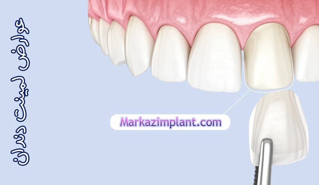 عوارض لمینت دندان laminate side effect
