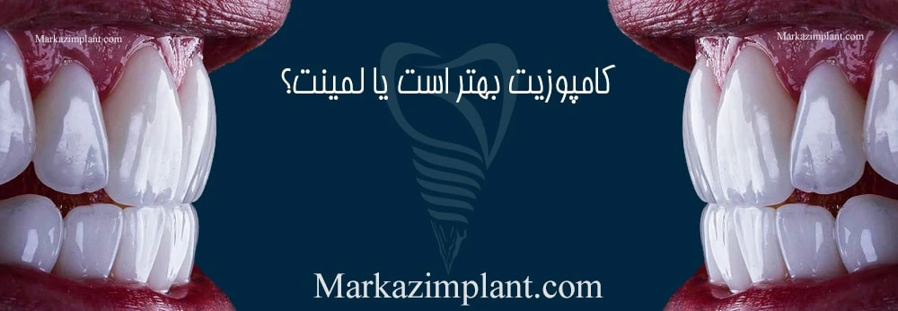 تفاوت کامپوزیت و لمینت laminate vs composite