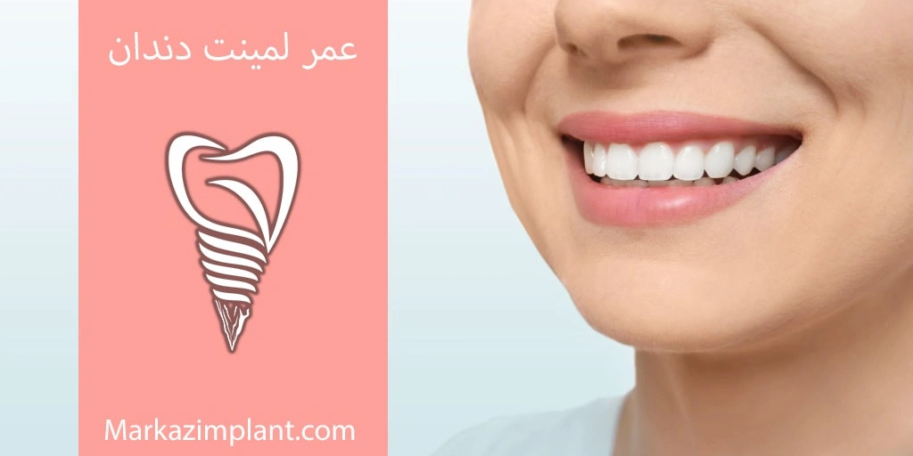 طول عمر لمینت دندان life time laminat