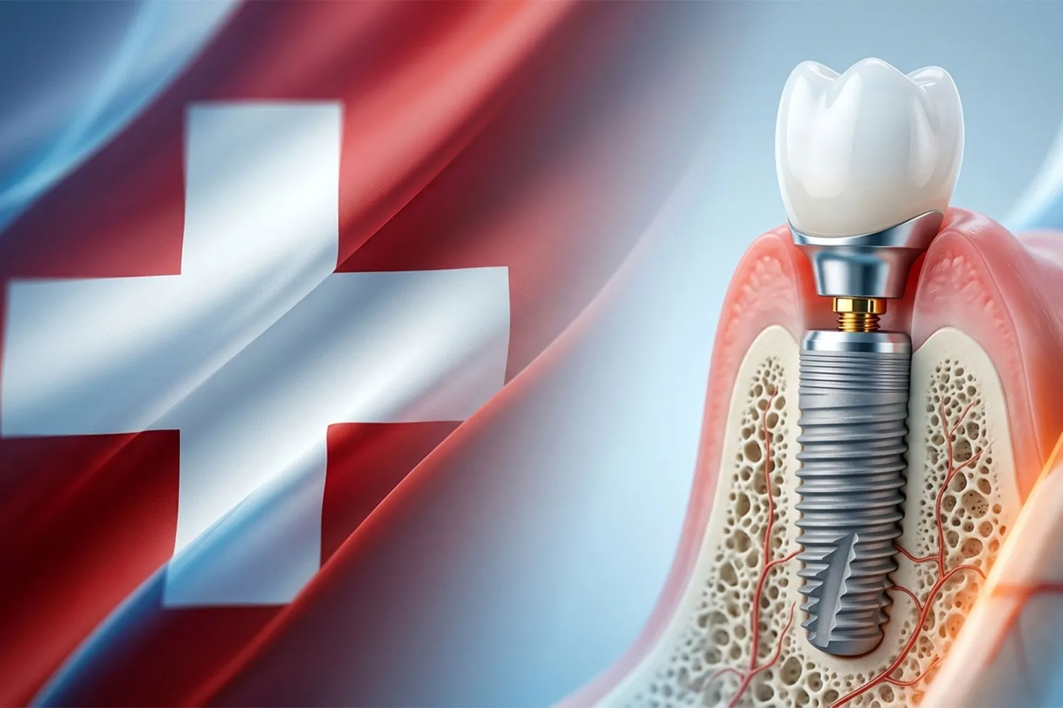 ایمپلنت اس جی اس sgs implant