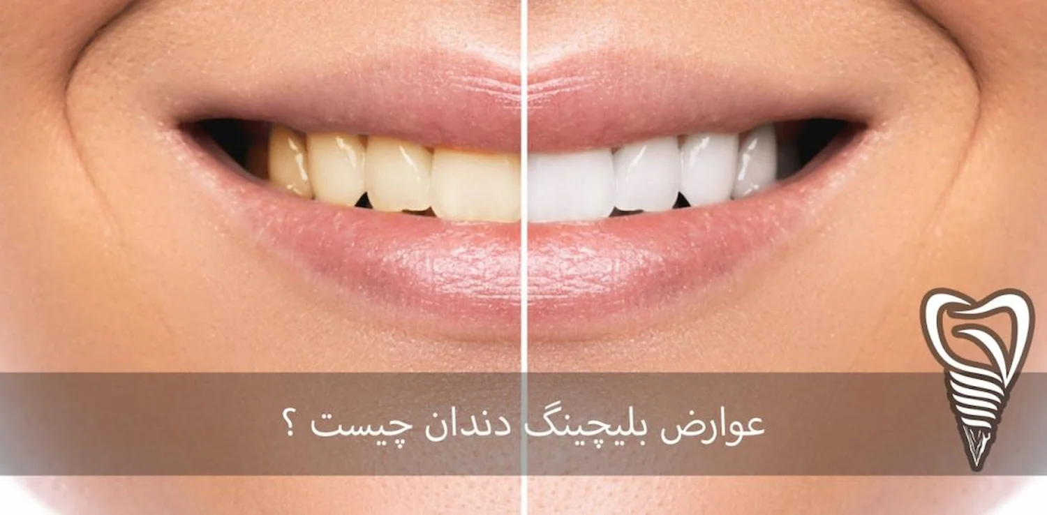 عوارض بلیچینگ دندان چیست