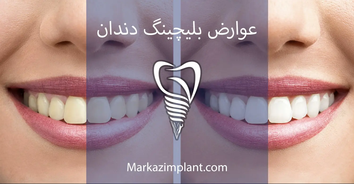 عوارض بلیچینگ و سفید کردن دندان side effect bleaching