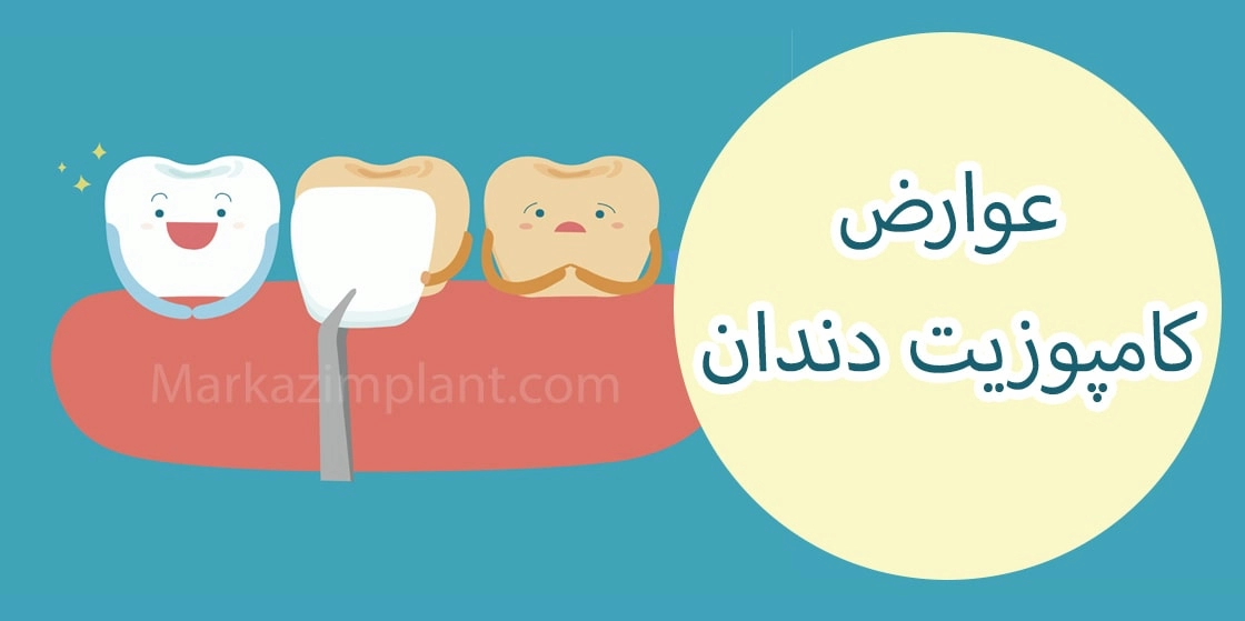 عوارض کامپوزیت دندان dental composite side effect