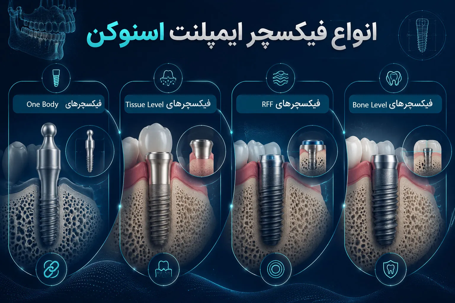 انواع فیکسچر ایمپلنت اسنوکن snucone implant fixture types