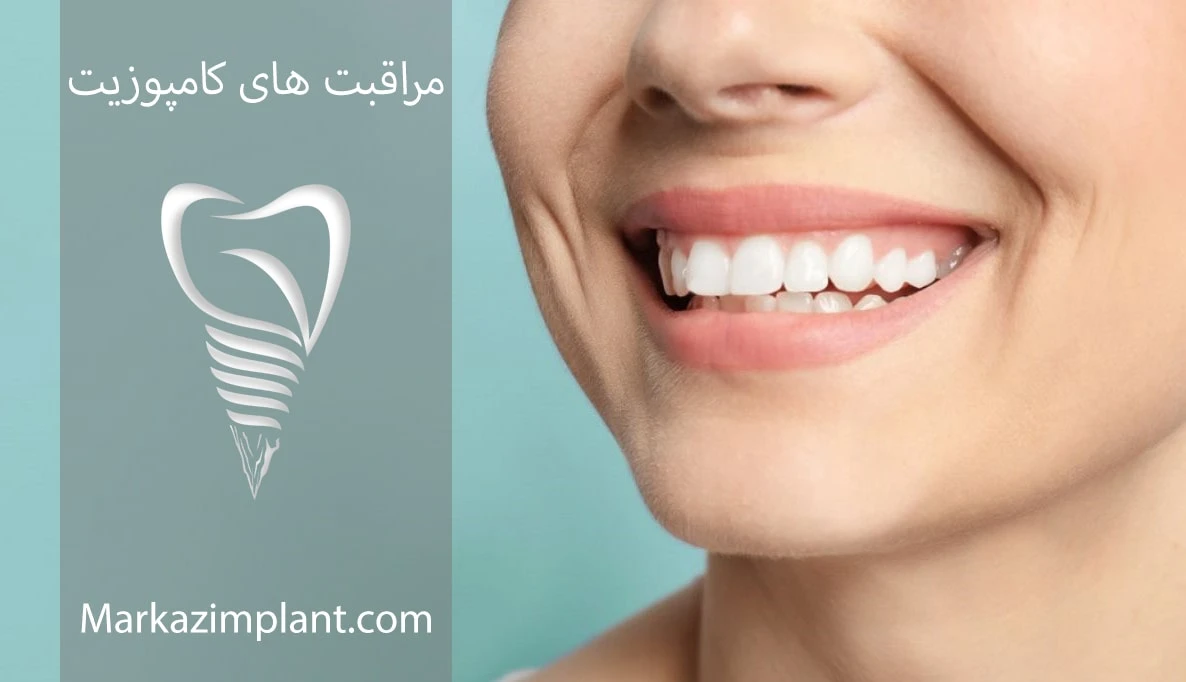 مراقبت از کامپوزیت دندان veneer composite care