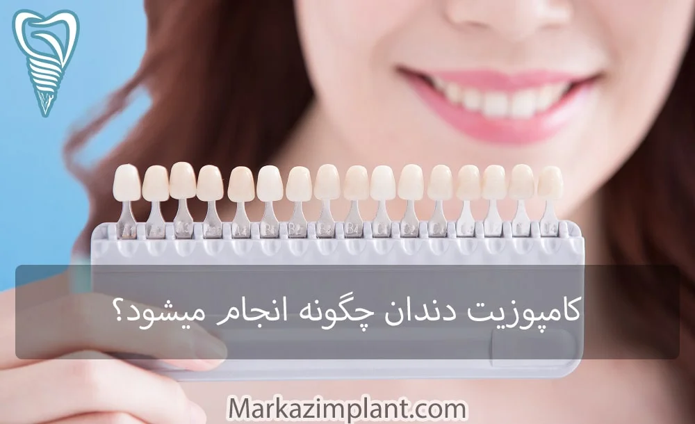 مراحل کامپوزیت دندان veneers composite steps
