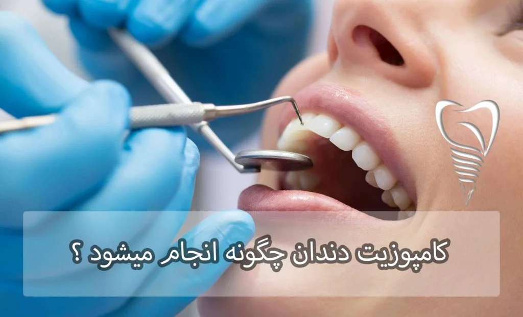 کامپوزیت دندان چگونه انجام می‌شود