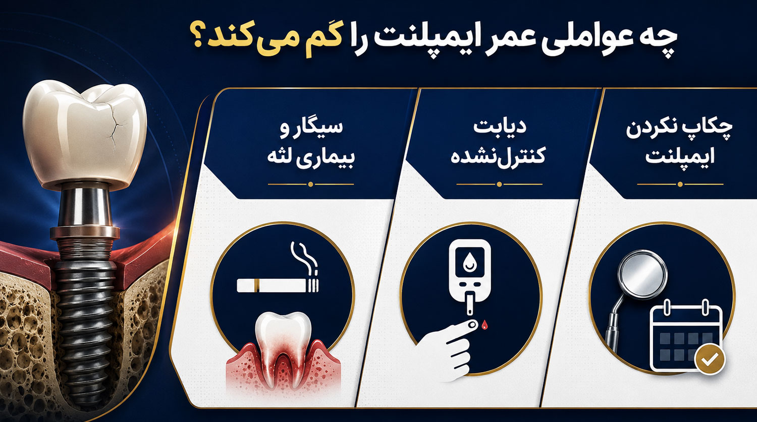 عوامل کاهش دهنده عمر ایمپلنت
