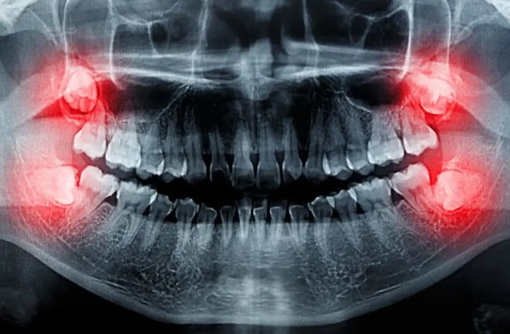 جراحی دندان عقل wisdom teeth surgery