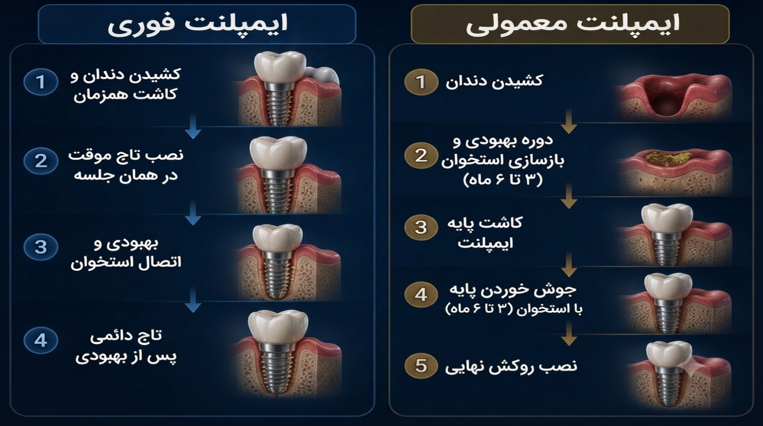 تفاوت ایمپلنت فوری و معمولی