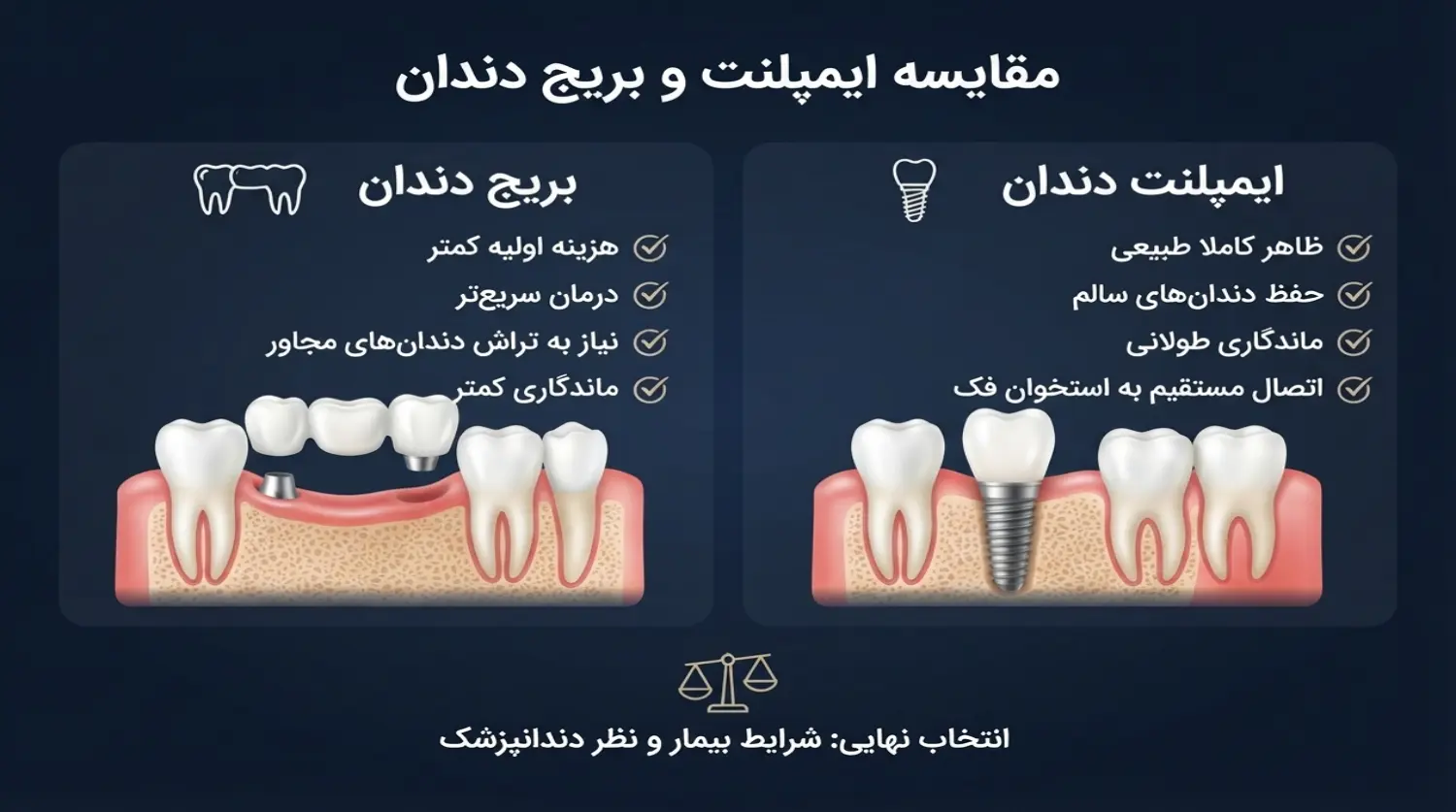 مقایسه ایمپلنت و بریج