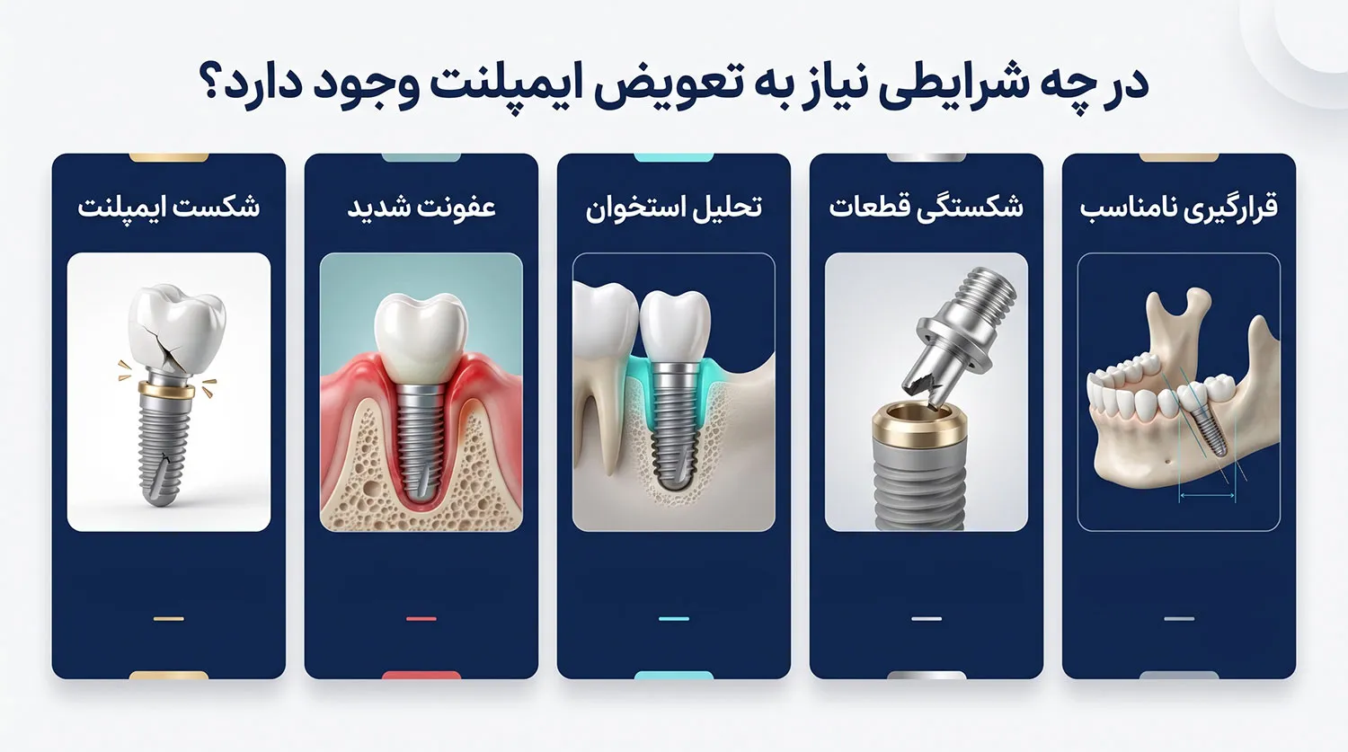 شرایط مهم برای تعویض ایمپلنت