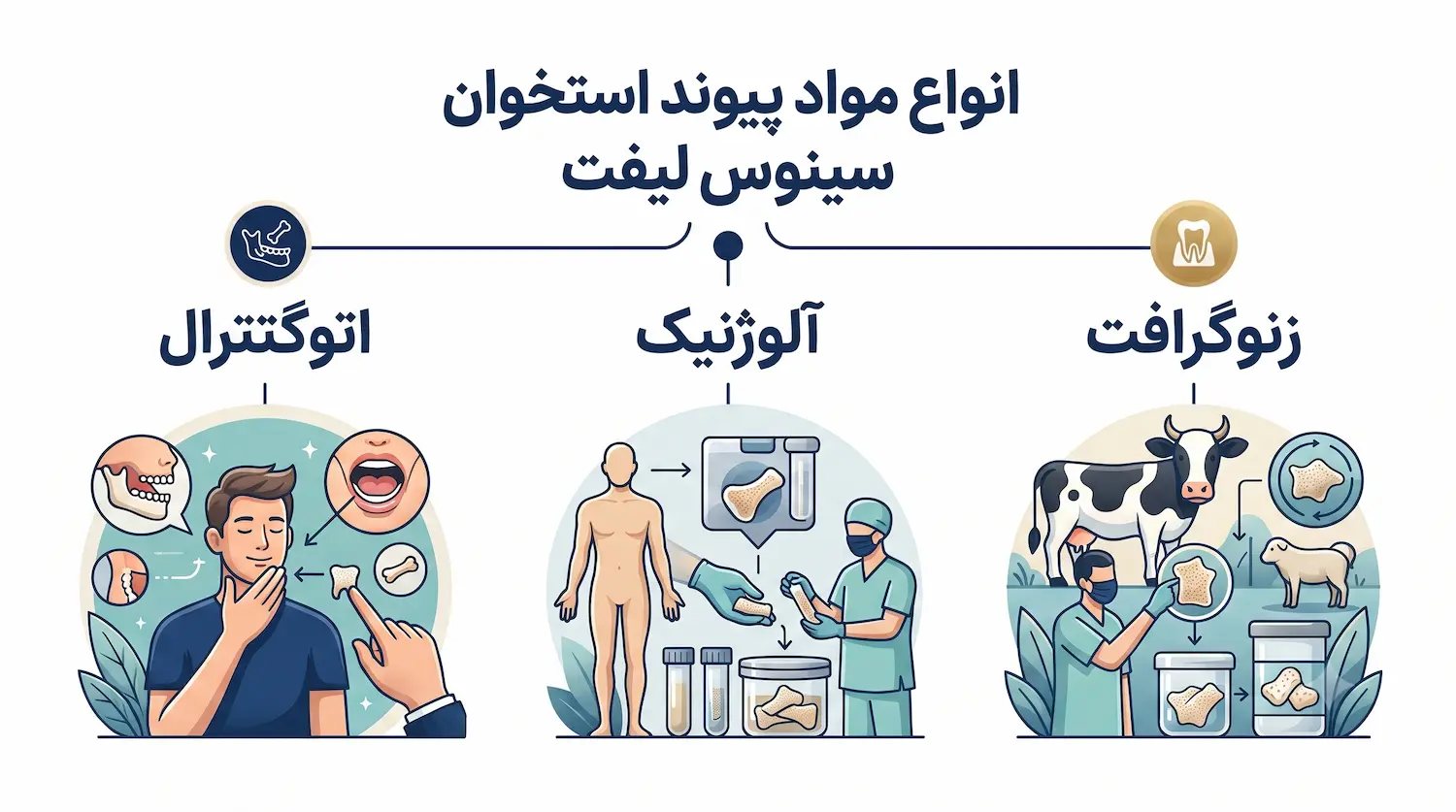 انواع مواد پیوند استخوان سینوس لیفت