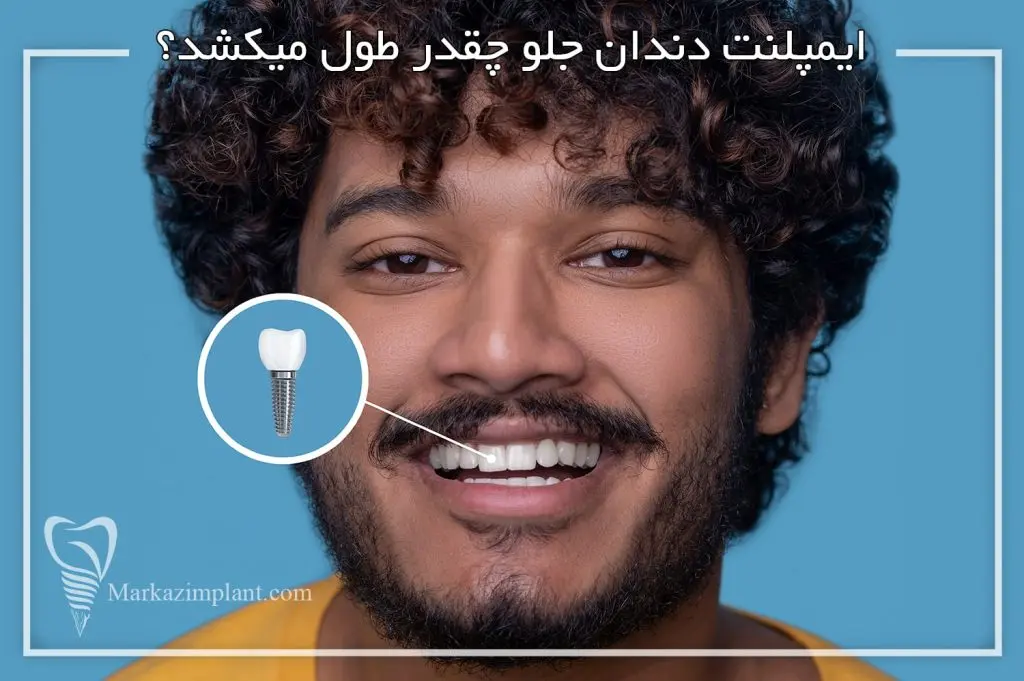 ایمپلنت دندان جلو چقدر طول میکشد