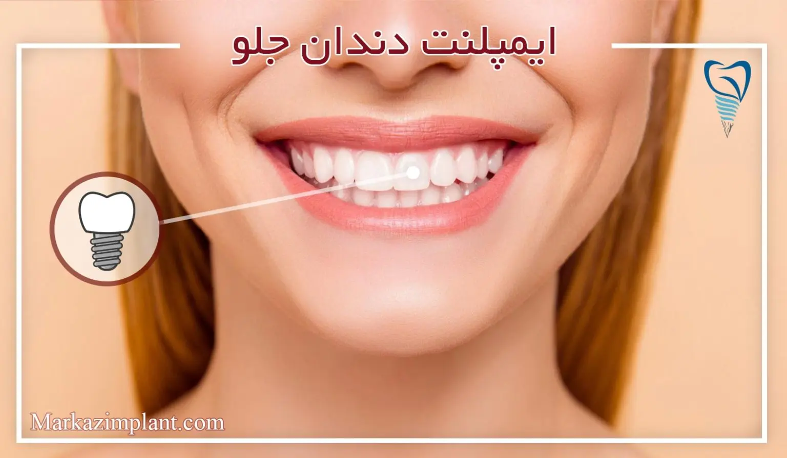 ایمپلنت دندان جلو dental-implant-front-tooth