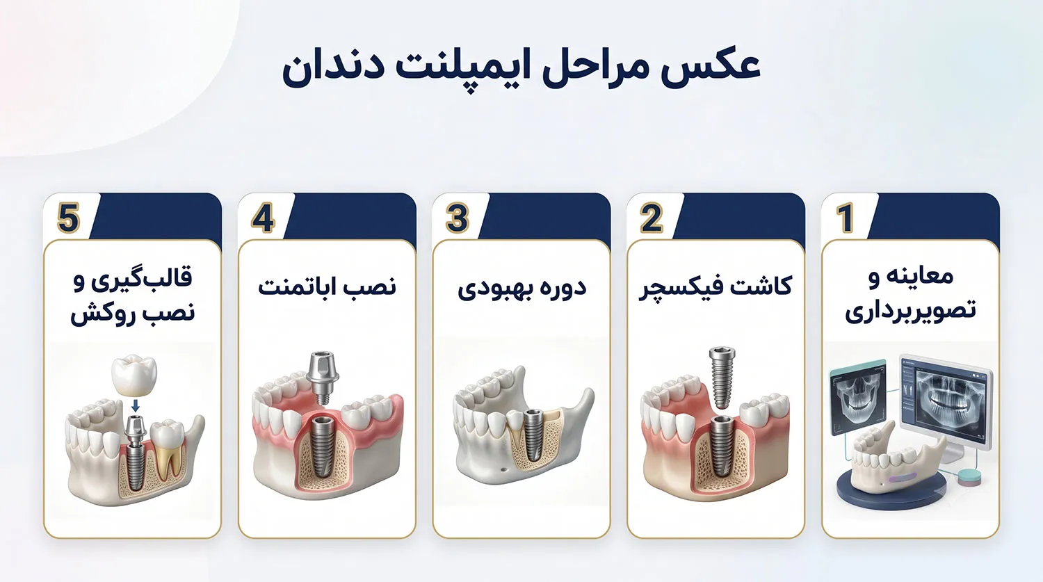 عکس مراحل ایمپلنت دندان
