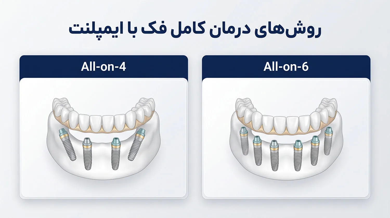 روش های ایمپلنت کامل یک فک