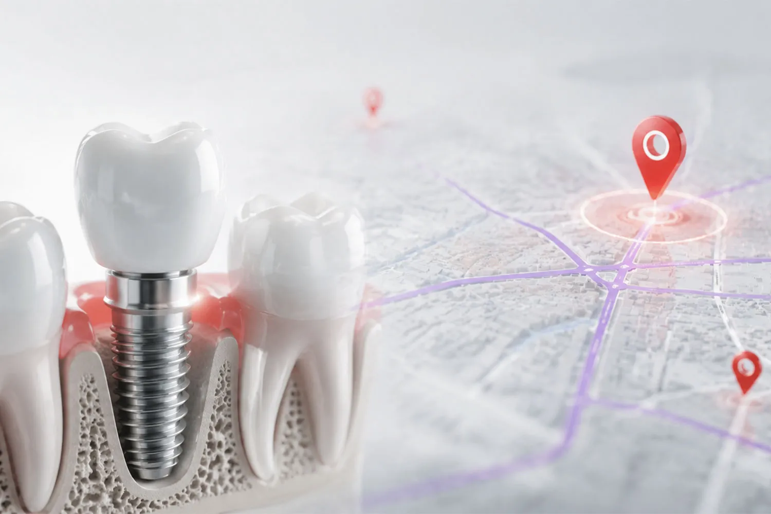بهترین مرکز ایمپلنت در شمال تهران north tehran best implant center