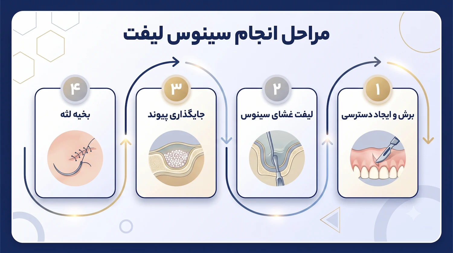 مراحل انجام سینوس لیفت