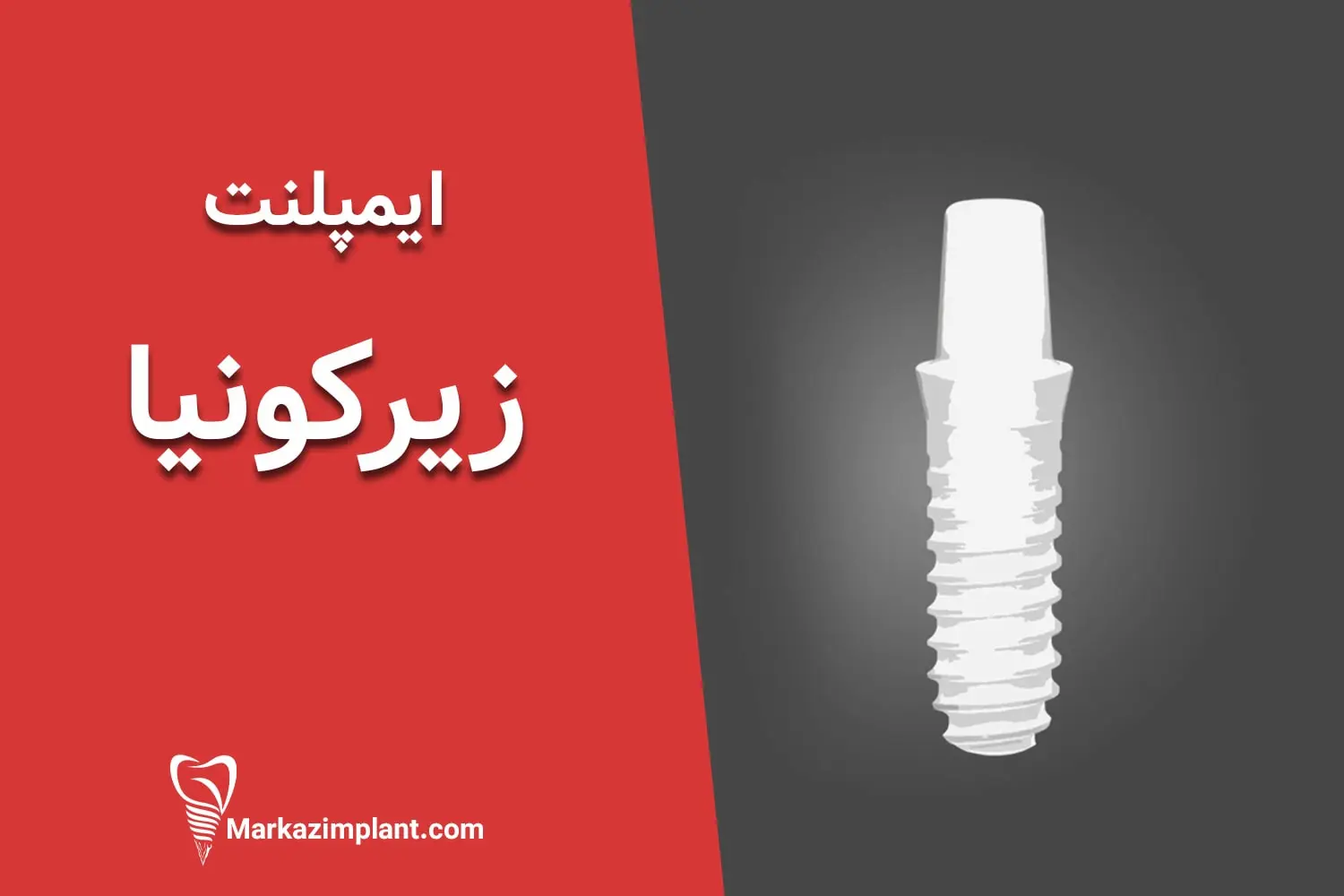 ایمپلنت زیرکونیا